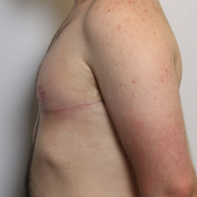 Female To Male Top Surgery 07