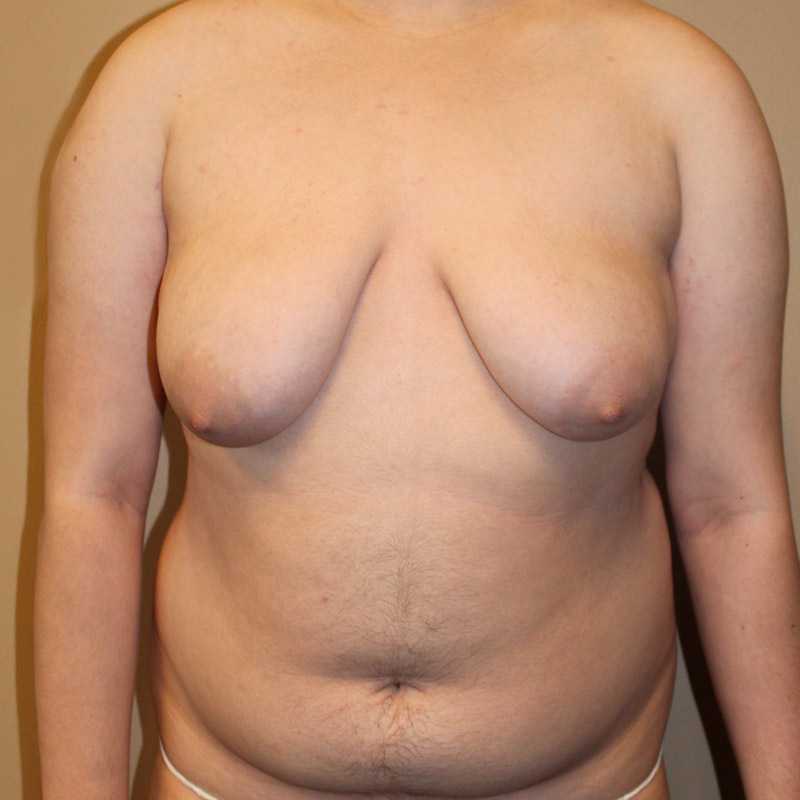 Female To Male Top Surgery 01