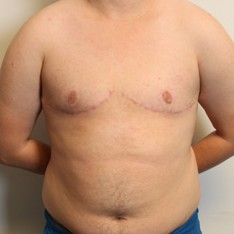 Female To Male Top Surgery 39