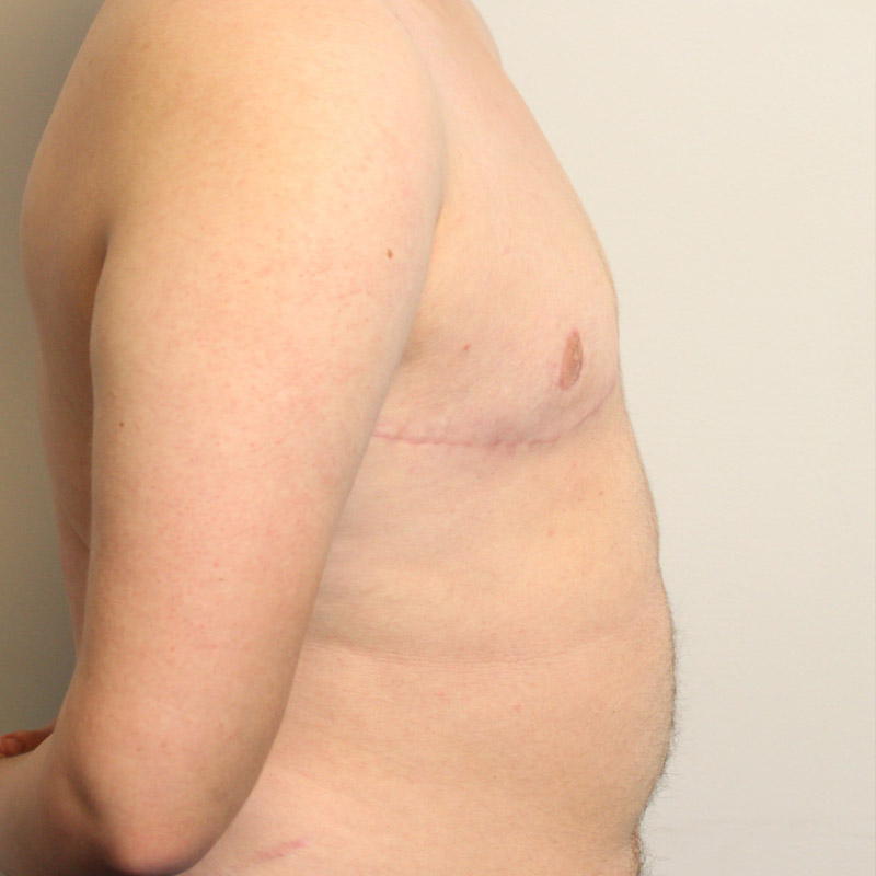 Female To Male Top Surgery 09