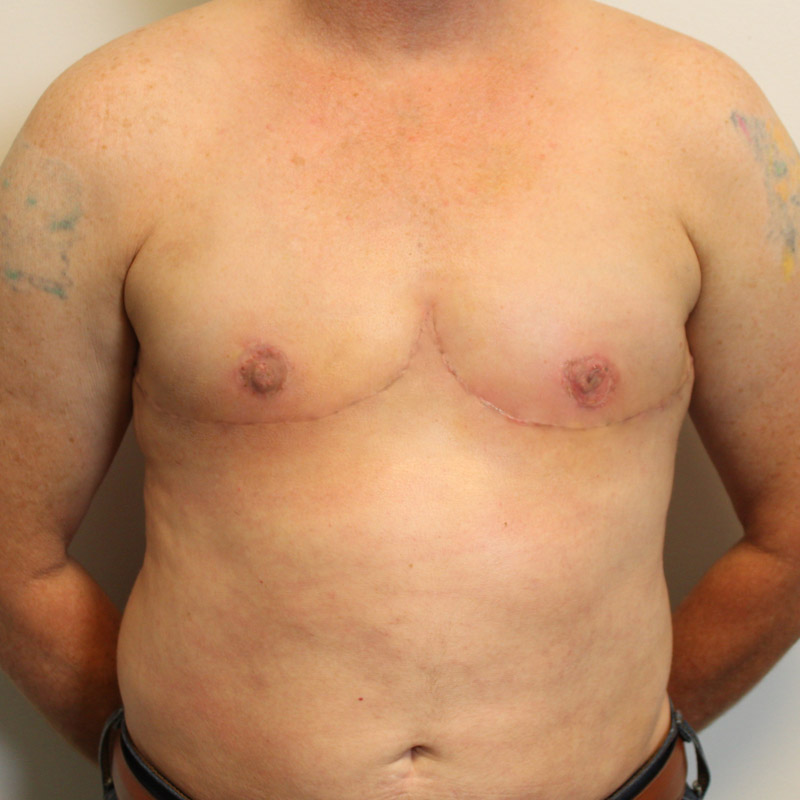 Female To Male Top Surgery 40