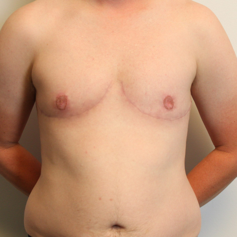 Female To Male Top Surgery 41