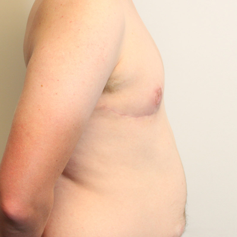 Female To Male Top Surgery 03