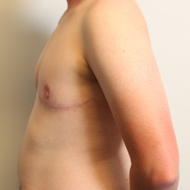 Female To Male Top Surgery 09