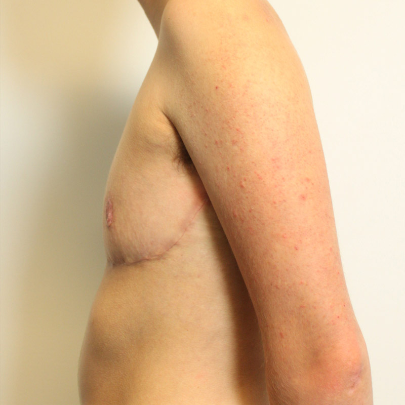 Female To Male Top Surgery 03