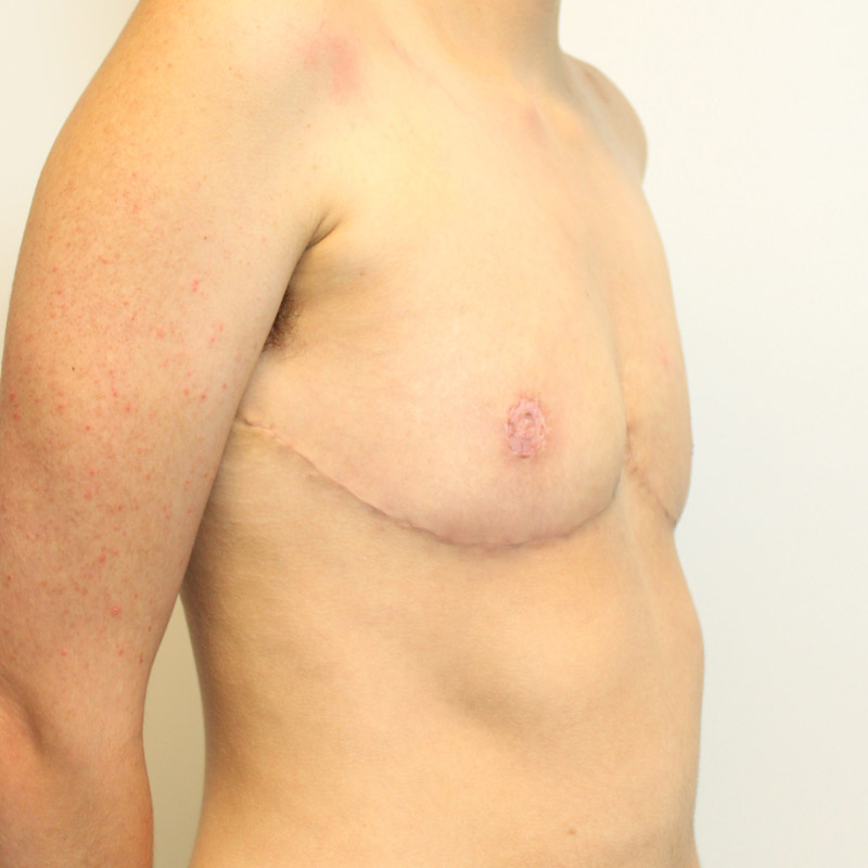 Female To Male Top Surgery 05