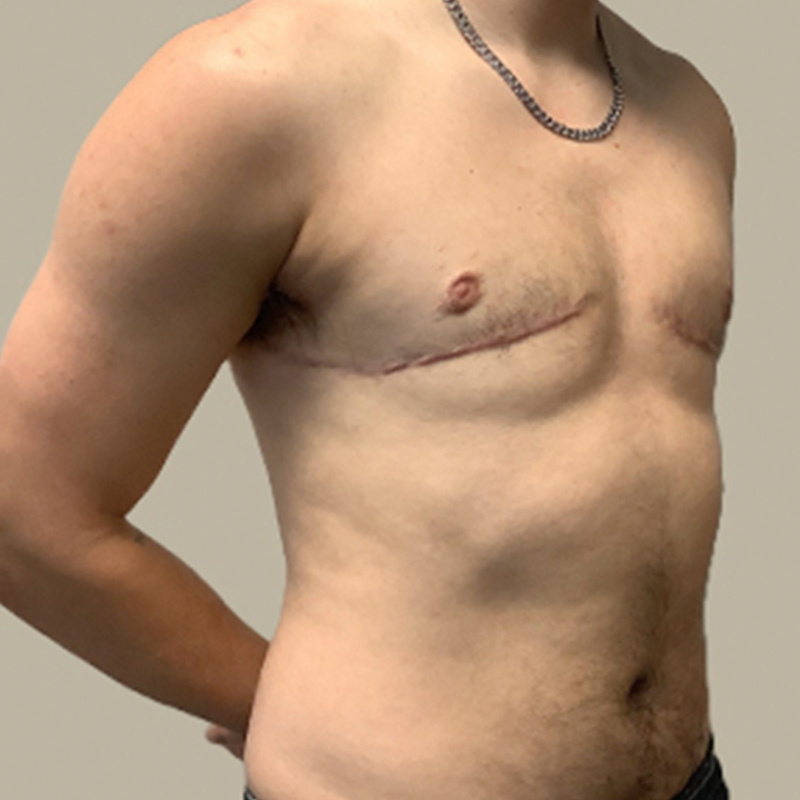 Female To Male Top Surgery 07