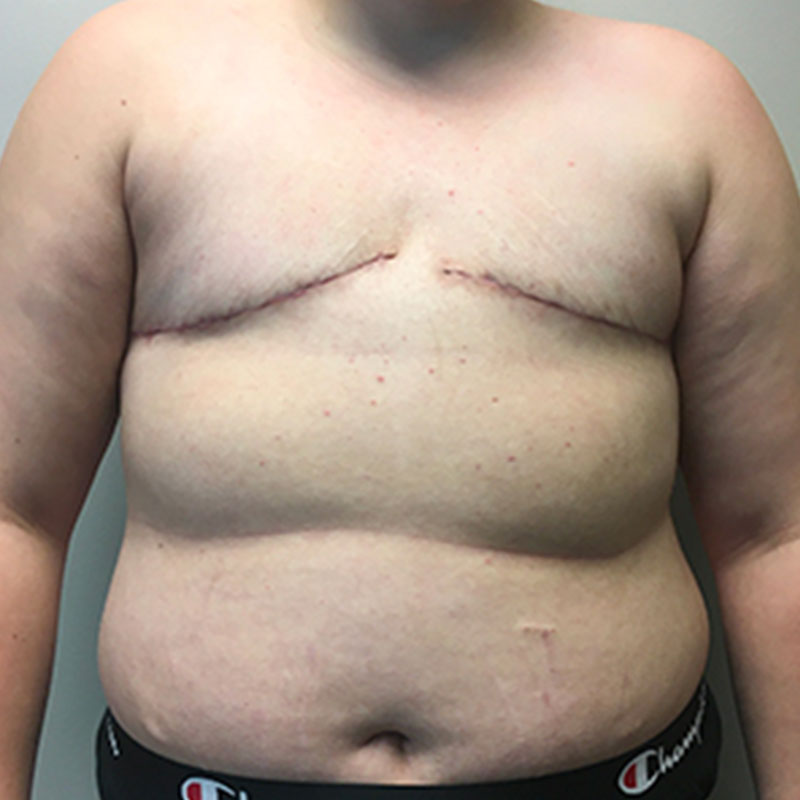 Female To Male Top Surgery 44