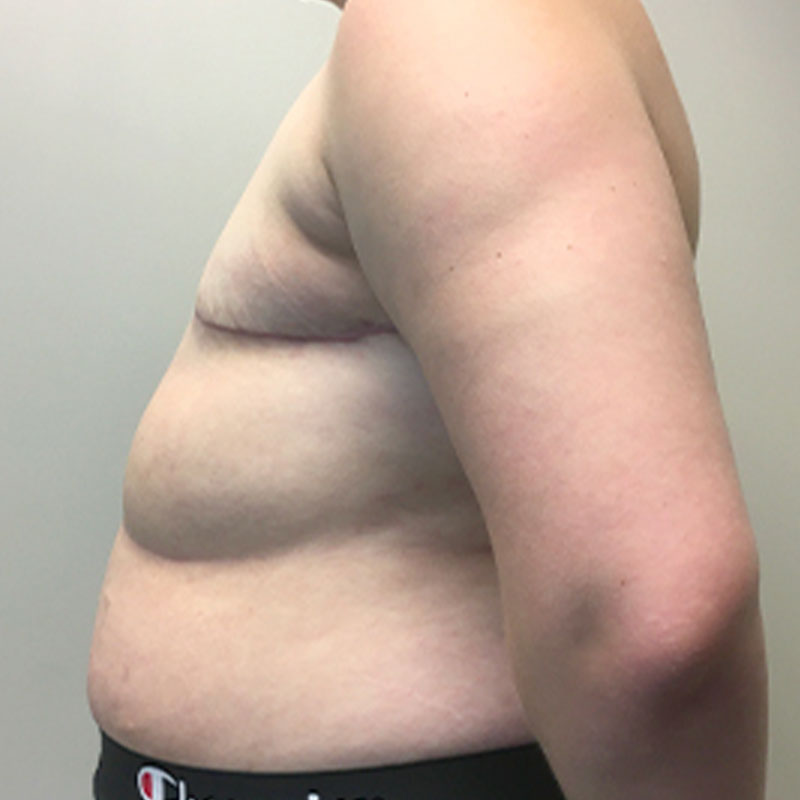 Female To Male Top Surgery 05