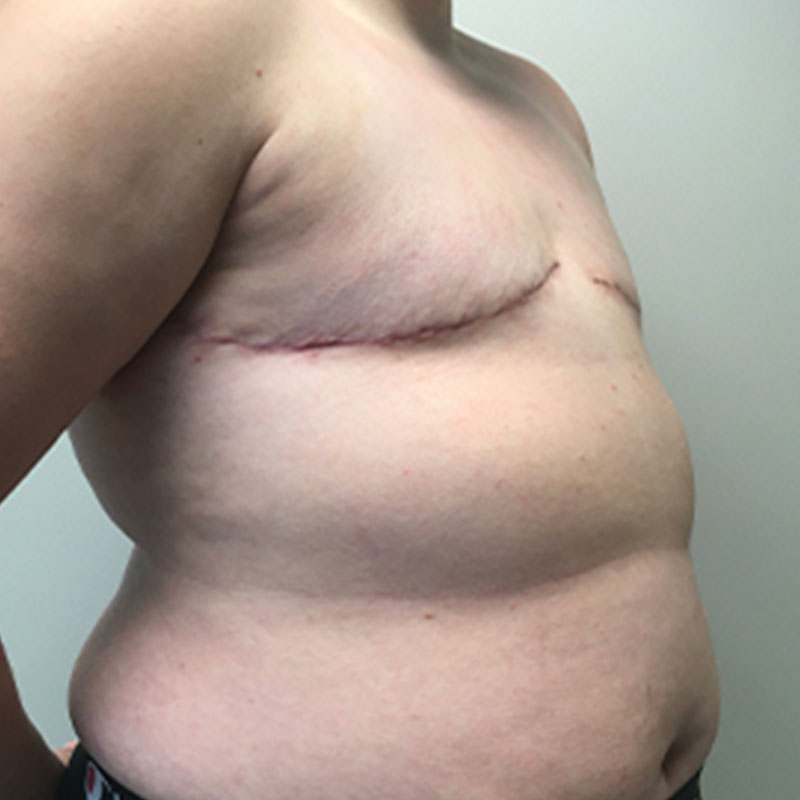 Female To Male Top Surgery 07