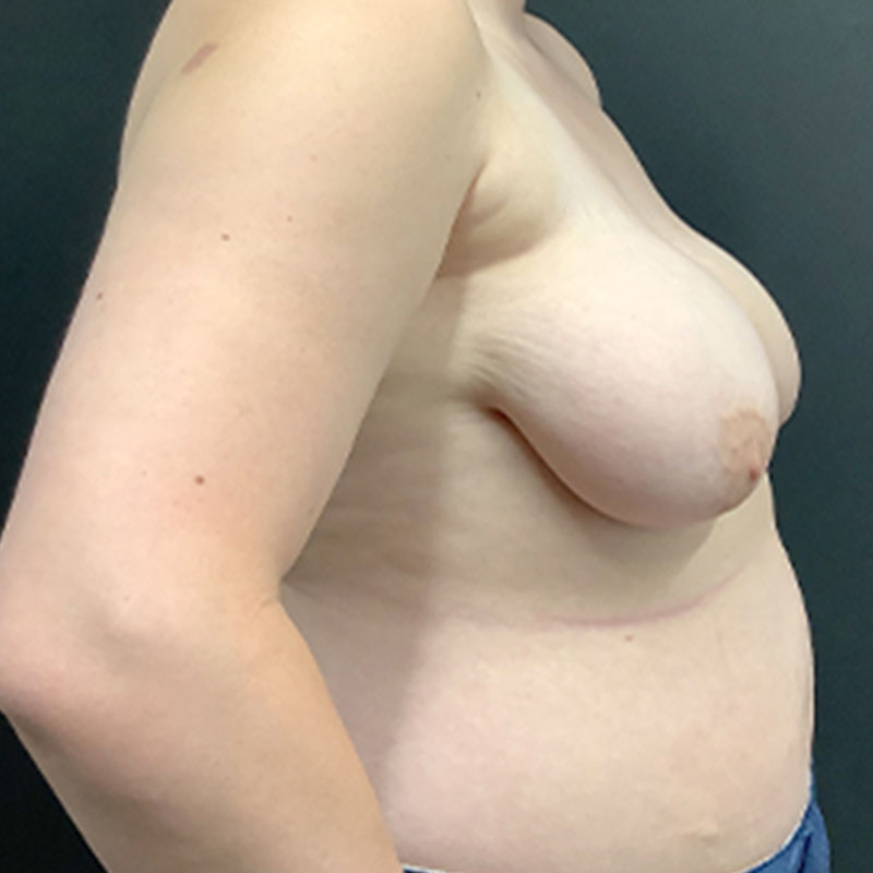 Female To Male Top Surgery 09