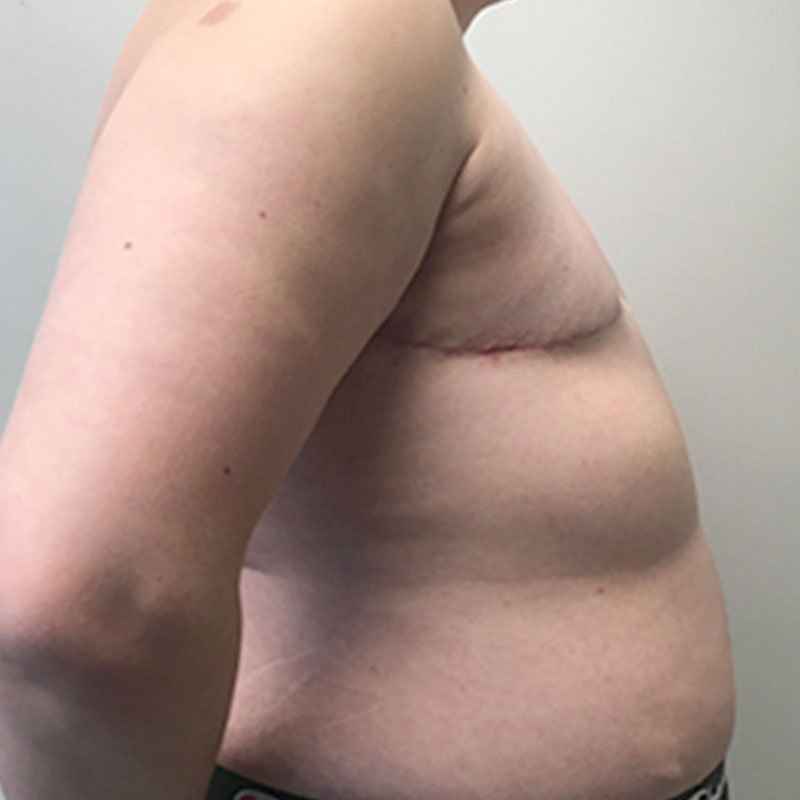 Female To Male Top Surgery 09