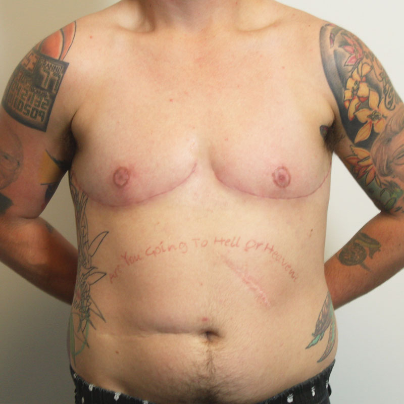 Female To Male Top Surgery 45