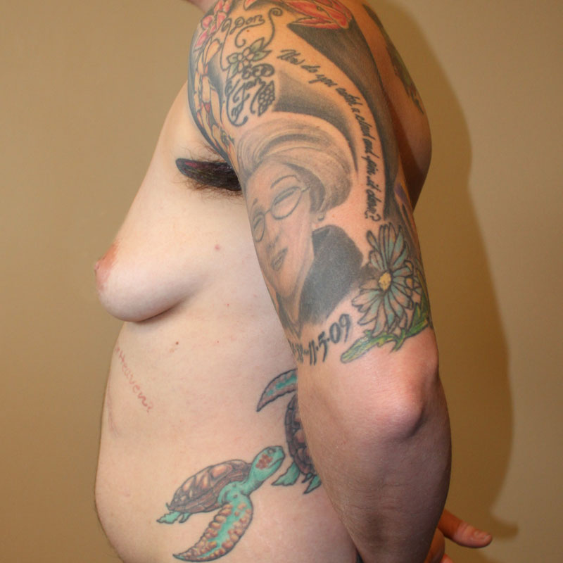 Female To Male Top Surgery 07