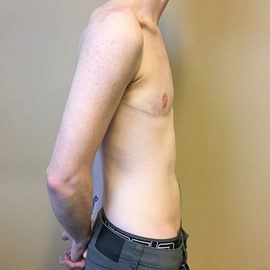 Female To Male Top Surgery 05