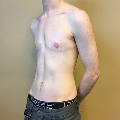 Female To Male Top Surgery 07