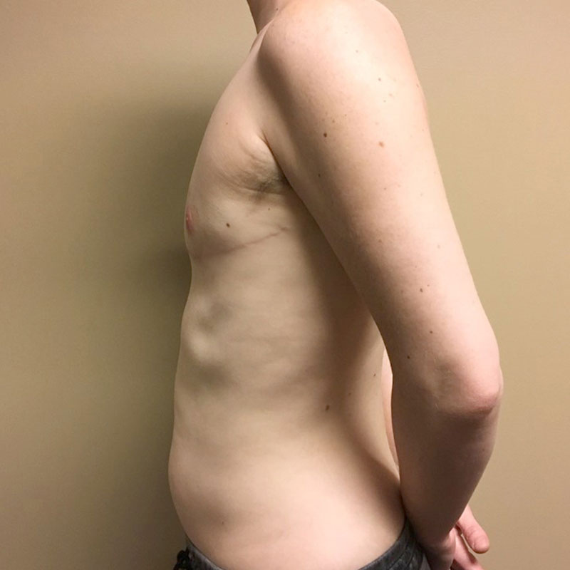 Female To Male Top Surgery 03