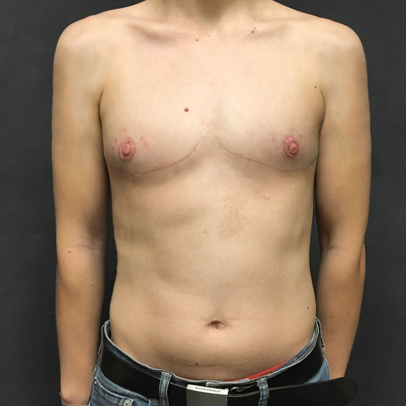 Female To Male Top Surgery 48