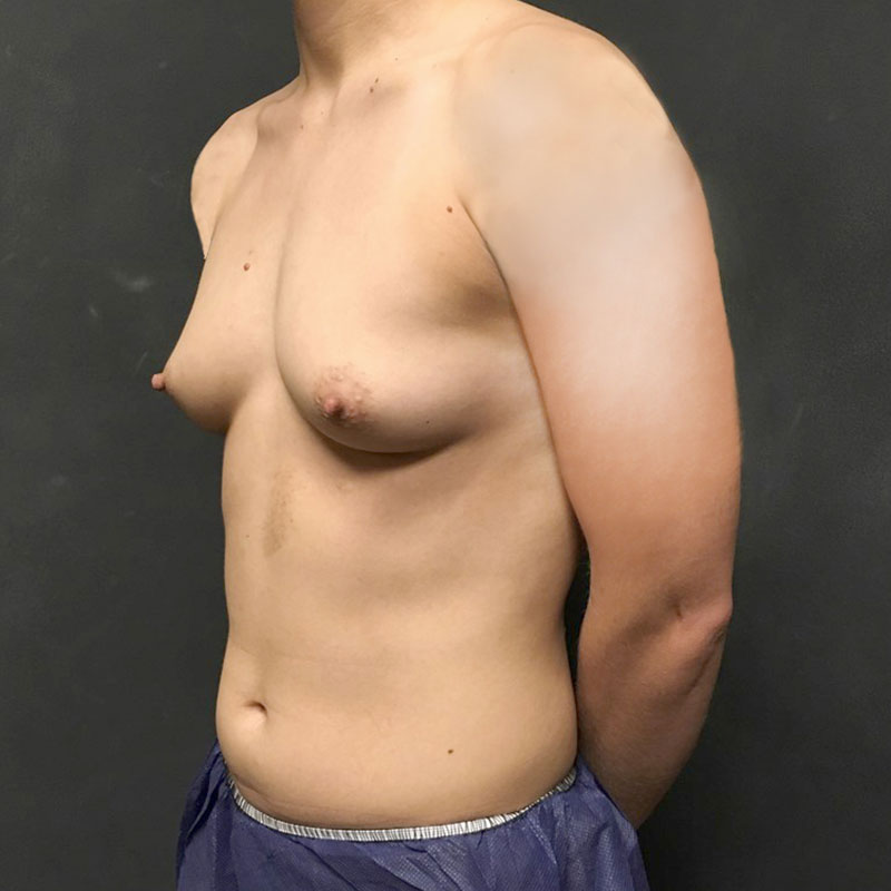 Female To Male Top Surgery 03