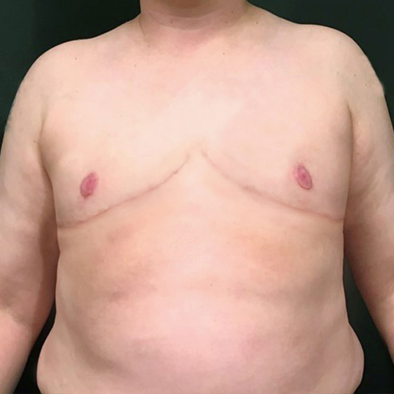 Female To Male Top Surgery 49