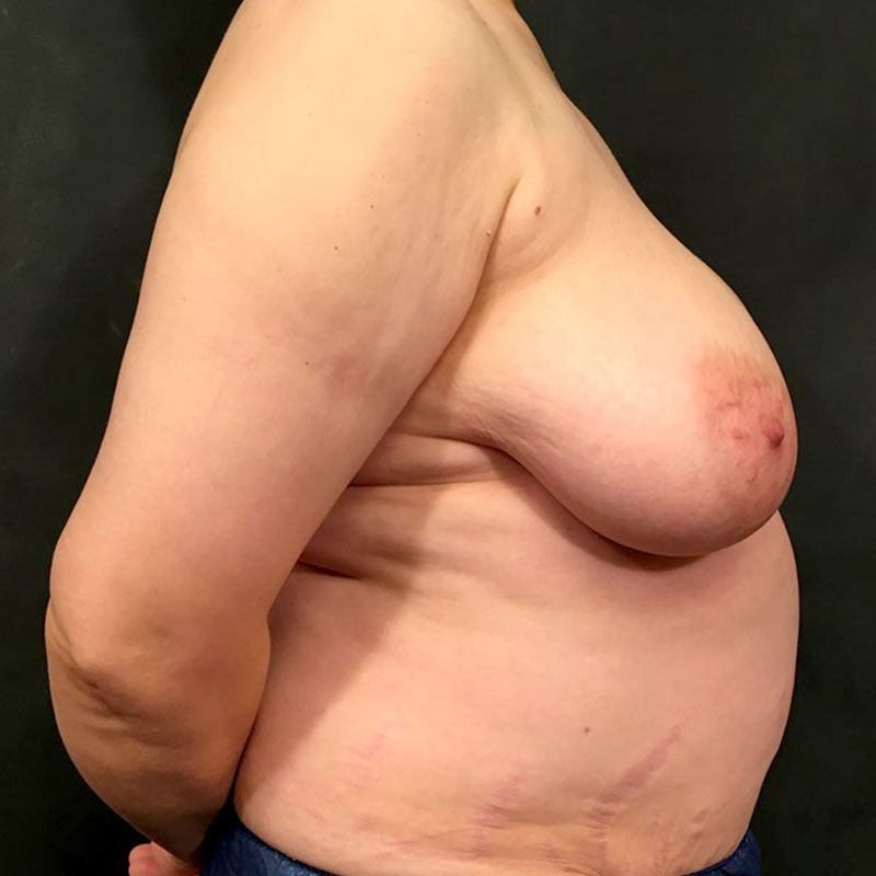 Female To Male Top Surgery 05