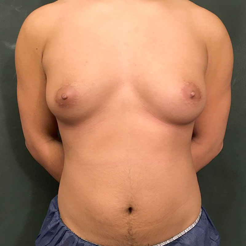 Female To Male Top Surgery 01