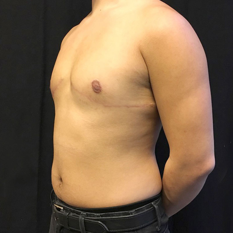 Female To Male Top Surgery 03