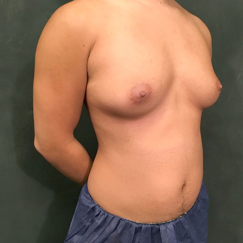 Female To Male Top Surgery 05