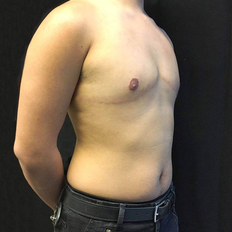 Female To Male Top Surgery 05