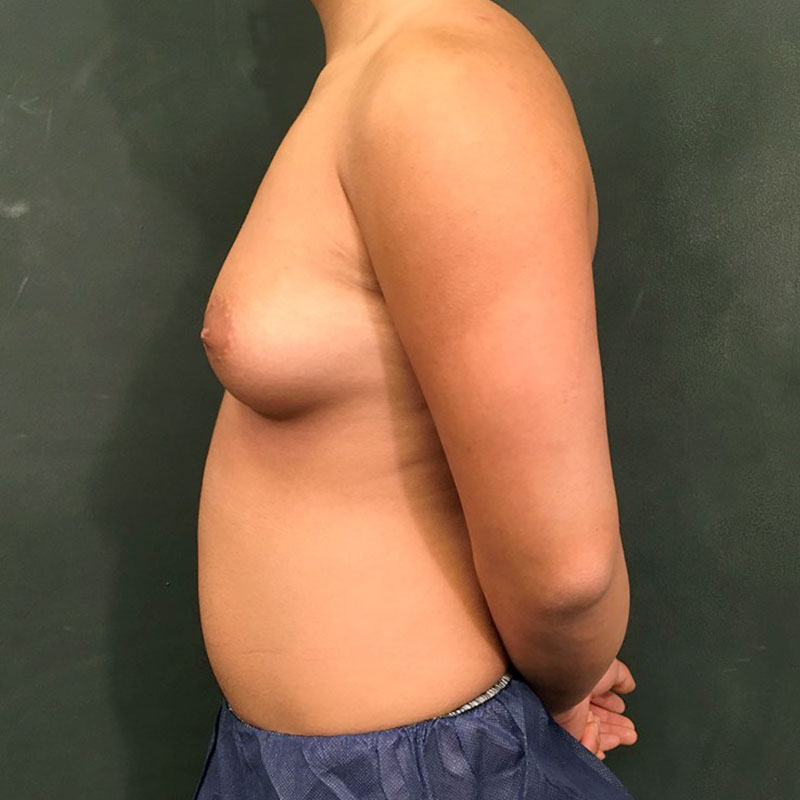 Female To Male Top Surgery 09