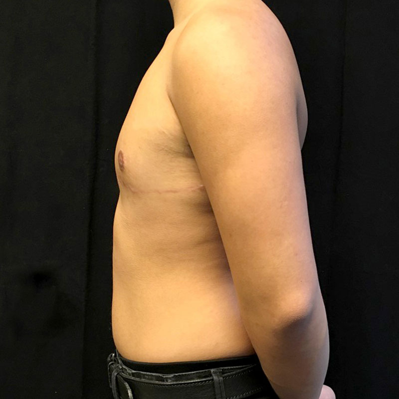 Female To Male Top Surgery 09