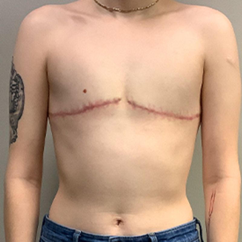 Female To Male Top Surgery 51