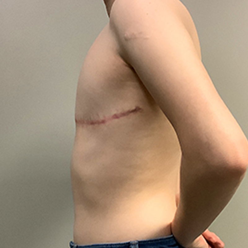 Female To Male Top Surgery 05