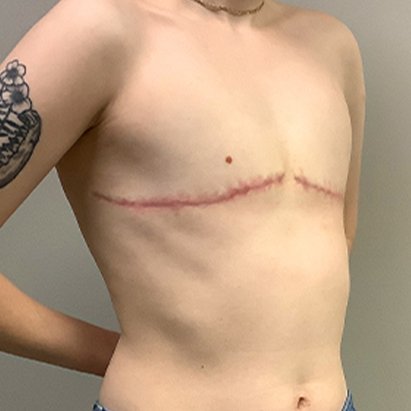 Female To Male Top Surgery 07