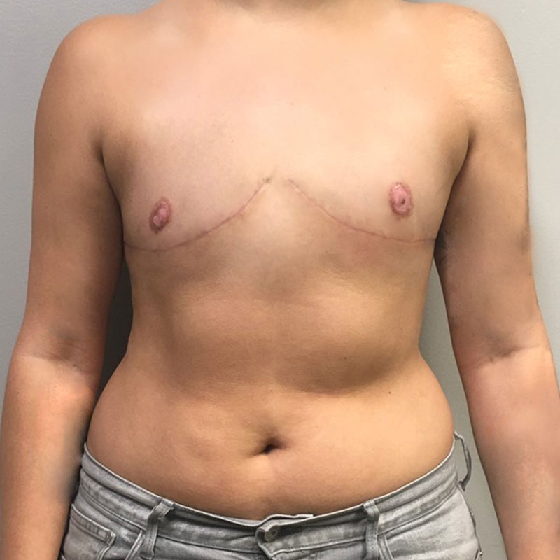 Female To Male Top Surgery 53