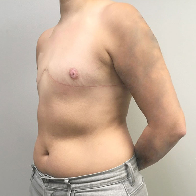 Female To Male Top Surgery 03