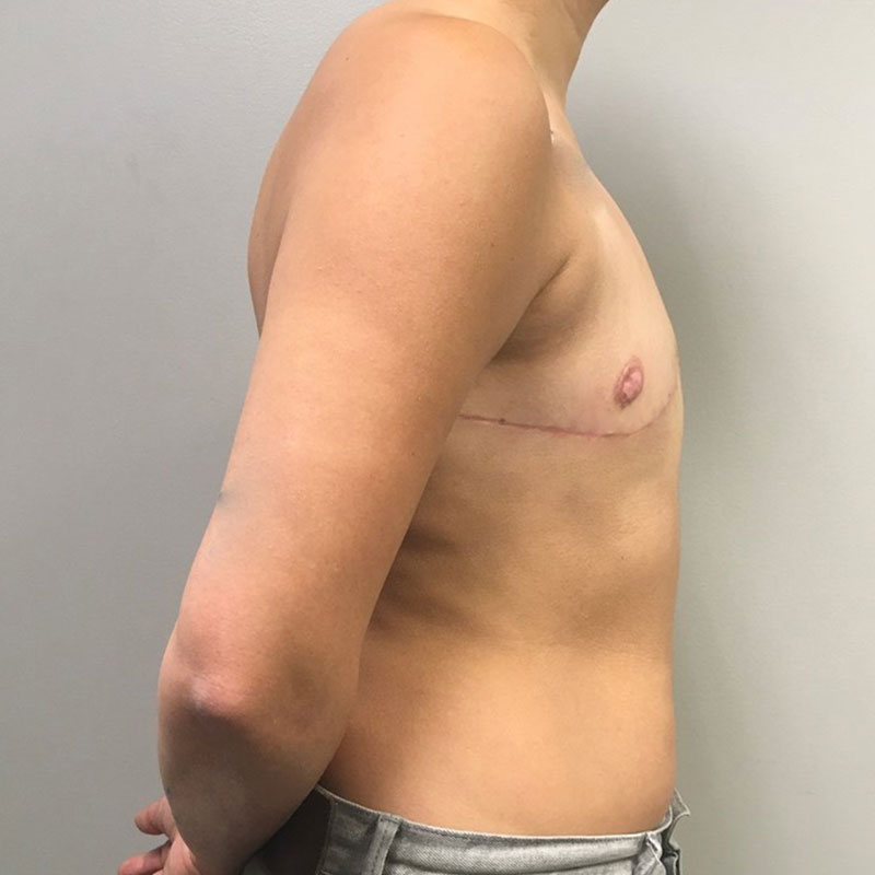 Female To Male Top Surgery 09