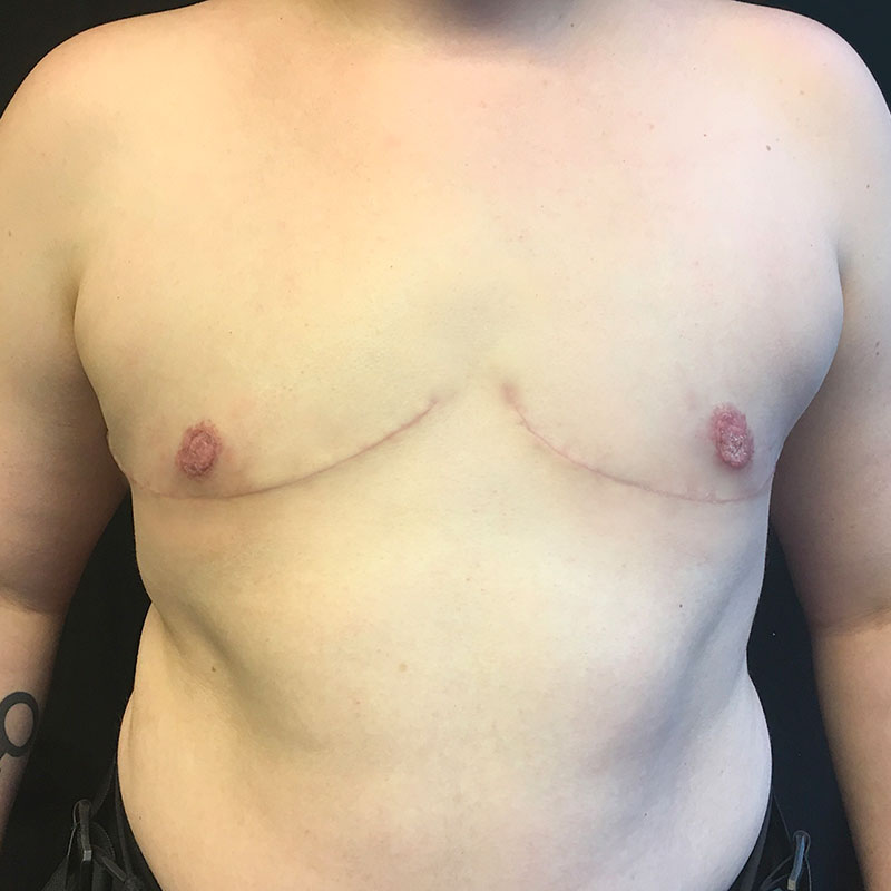 Female To Male Top Surgery 54