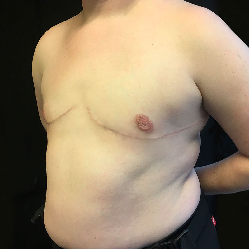 Female To Male Top Surgery 03