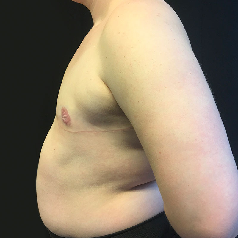 Female To Male Top Surgery 05