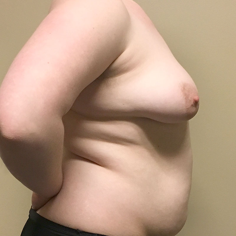 Female To Male Top Surgery 07