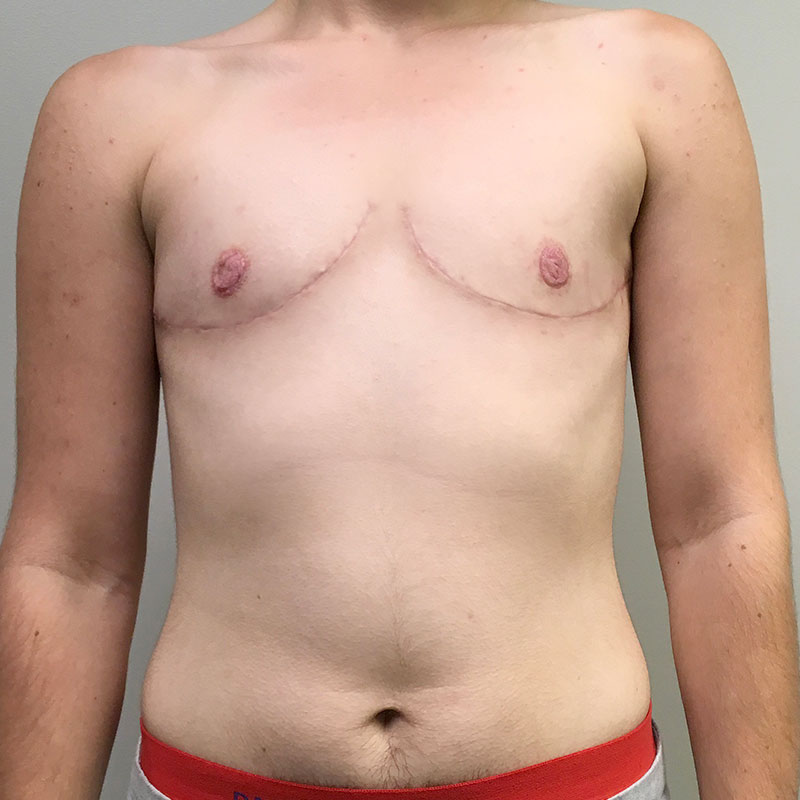 Female To Male Top Surgery 55