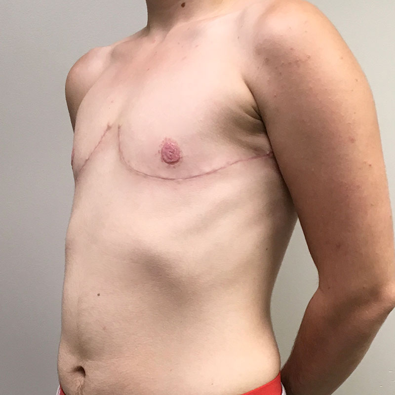 Female To Male Top Surgery 03