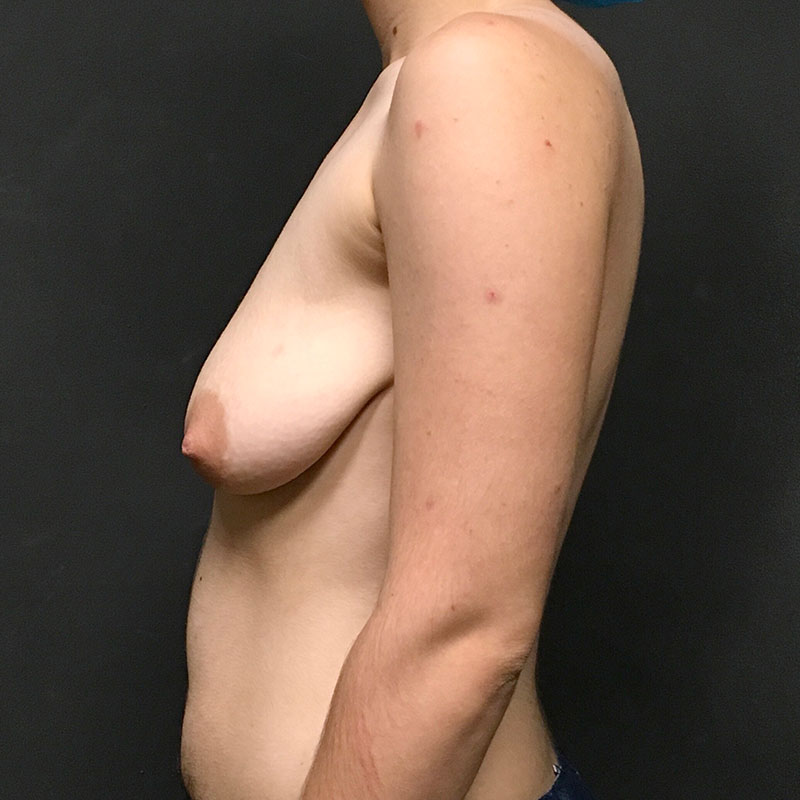 Female To Male Top Surgery 05