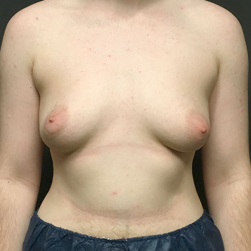 Female To Male Top Surgery 01