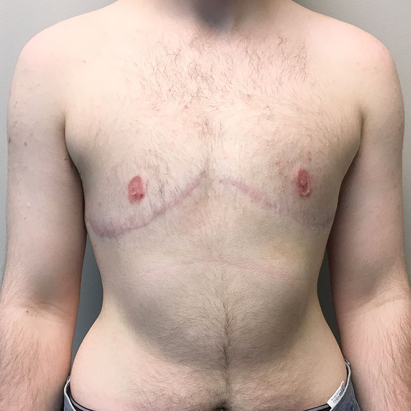 Female To Male Top Surgery 56