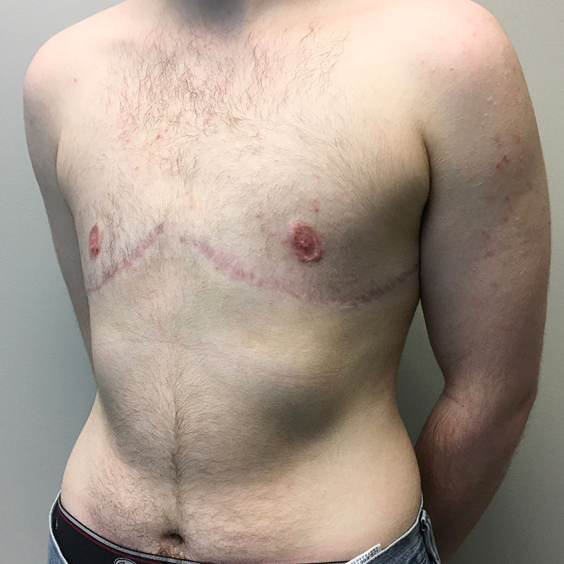 Female To Male Top Surgery 03