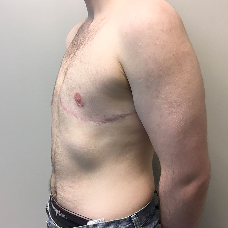 Female To Male Top Surgery 05