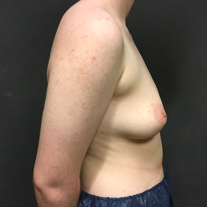 Female To Male Top Surgery 09