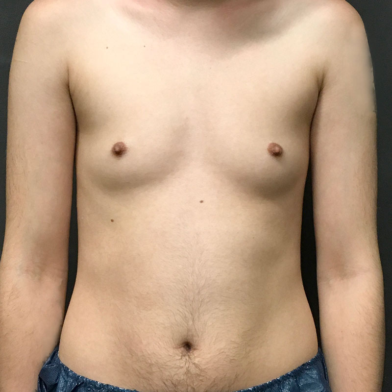 Female To Male Top Surgery 01